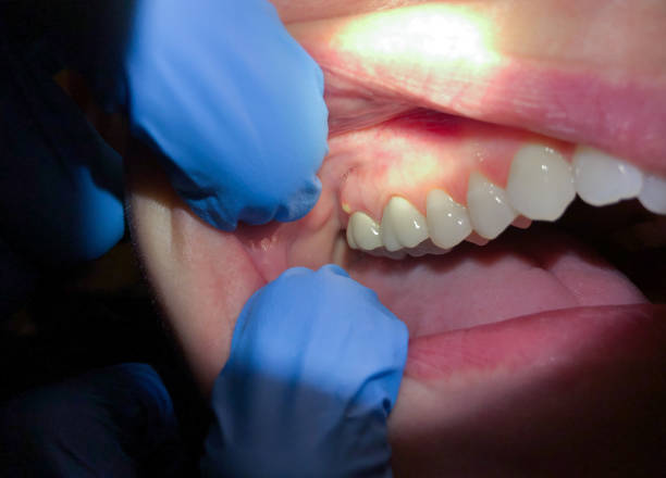 Best Emergency Dental Care for Broken or Chipped Teeth in Lyons, CO